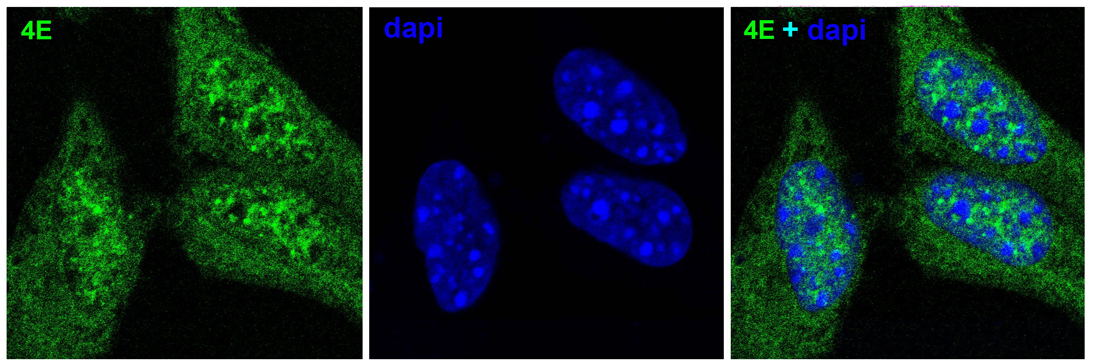 Pancreatic Cancer Cells
